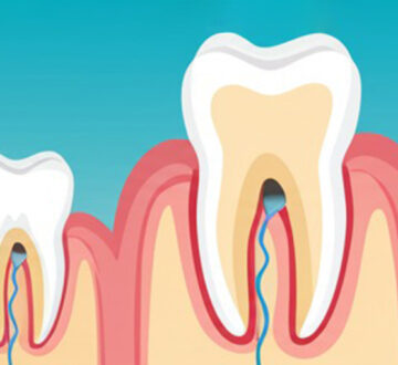 Are Root Canals Necessary Every Time Before a Dental Crown Treatment?