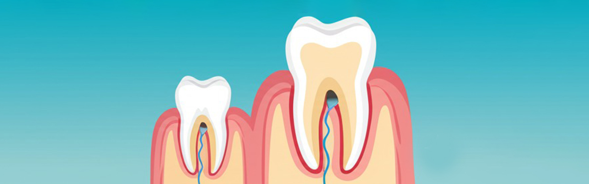 Are Root Canals Necessary Every Time Before a Dental Crown Treatment?